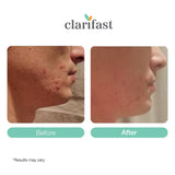 Clarifast One-Step Acne Treatment